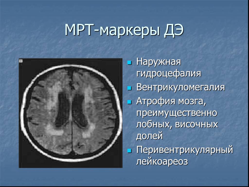Атрофия полушарий. Кт атрофия мозга наружная гидроцефалия. Наружная гидроцефалия головного мозга кт. Мрт картина наружной гидроцефалии. Наружная гидроцефалия головного мозга мрт.