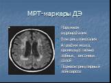 МРТ-маркеры ДЭ. Наружная гидроцефалия Вентрикуломегалия Атрофия мозга, преимущественно лобных, височных долей Перивентрикулярный лейкоареоз