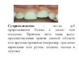 Супраположение – когда зуб прорезывается ближе к десне, чем соседние. Причина этого чаще всего предшествующая травма данной области или вредная привычка (например, грызение карандаша или ручки, сосание пальца в детстве).