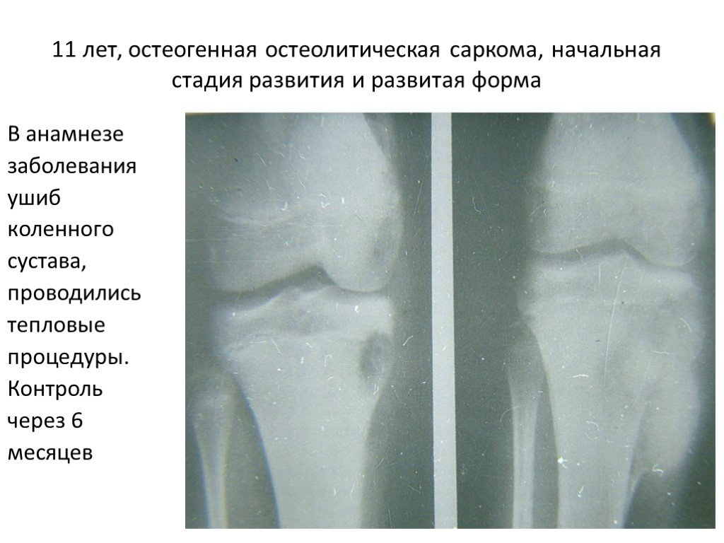 Степени саркомы. Остеогенная саркома рентген. Остеолитическая саркома кости. Остеобластическая и остеолитическая саркома. Остеогенная саркома стадии.