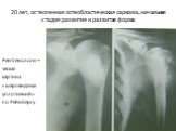 20 лет, остеогенная остеобластическая саркома, начальная стадия развития и развитая форма. Рентгенологи – ческая картина «шаровидных уплотнений» по Рейнбергу