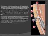 Трахеотомия - рассечение колец трахеи, этап трахеостомии. Оправдано называть трахеотомией операцию вскрытия трахеи для проведения эндотрахеального или эндобронхиального вмешательства с последующим зашиванием раны. Трахеостомия - образование временного или стойкого соустья полости трахеи с окружающей