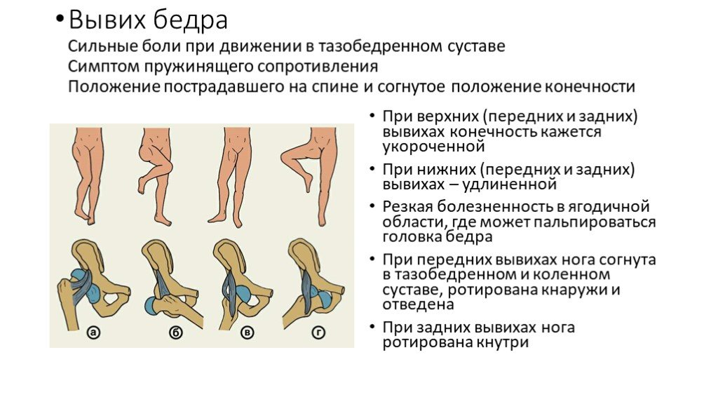 Локальный статус нижних конечностей. Антеторсия тазобедренных суставов. Вывих тазобедренного сустава классификация. Характерные симптомы травматического вывиха бедра.