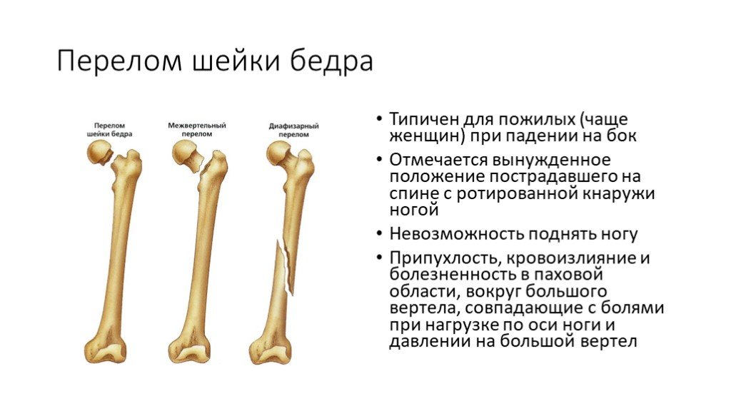 Боли при переломе шейки бедра. Чрезвертельные переломы бедренной кости классификация. Классификация переломов шеек бедренной кости. Шейка левой бедренной кости. Перелом вертельной зоны бедра.