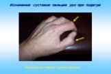 Изменения суставов пальцев рук при подагре. Подагрические «тофусы» указаны стрелками