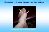 Изменения суставов пальцев ног при подагре