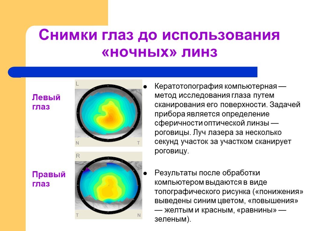 Правая и левая линза. Астигматизм кератотопография. Компьютерная кератотопография глаза. Кератопограмма роговицы. Кератотопография роговицы глаза.