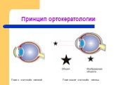 Принцип ортокератологии. Глаз с «ночной» линзой. Глаз после «ночной» линзы