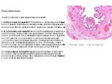 Классификация Микроснимок жёлчного пузыря при холецистите. 1.Катаральный холецистит. Его симптомы — интенсивные постоянные боли в правом подреберье и эпигастральной области с иррадиацией в поясничную область, правую лопатку, надплечье, правую половину шеи. 2.Флегмонозный холецистит имеет более выраж
