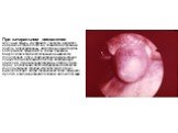 При катаральном воспалении желчный пузырь, как правило, увеличен в размере, напряжен, стенка его отечна, слизистая и серозный покров гиперемированы, имеется инъекция сосудов. Содержимое пузыря желчь, камни, паразиты. Микроскопическим исследованием выявляется полнокровие, отек и лейкоцитарная инфильт
