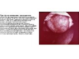 При флегмонозном холецистите (гнойном) желчный пузырь также увеличен в размере, резко напряжен, стенка его утолщена, инфильтрирована, покрыта фибрином, в просвете мутная желчь или гной, камни, слизь и т.д. Характеризуется диффузной инфильтрацией стенок желчного пузыря полиморфоядерными лейкоцитами, 