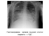 Рентгенограмма органов грудной клетки пациента с РДС