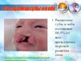 Расщелины губы и неба составляют 86,9% от всех врожденных пороков развития лица. http://www.volgograd.ru/theme/medic/stomatologiya/detskaya_stomatologiya/23256.pub. Расщелина губы и неба