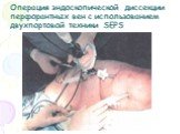 Операция эндоскопической диссекции перфорантных вен с использованием двухпортовой техники SEPS