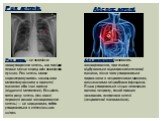 Рак легенів. Рак легень — це злоякісне новоутворення легень, що посідає перше місце серед всіх злоякісних пухлин. Рак легень може характеризуватись локальним метастазуванням в прилеглі тканинах або інші органи (віддалені метастази). Більшість типів раку легень (так звані первинні ракові захворювання