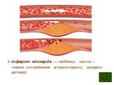 Інфаркт міокарда — найбільш часте і тяжке ускладнення атеросклерозу вінцевих артерій.