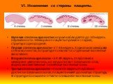 VI. Изменения со стороны плаценты. Нулевая степень зрелости в норме наблюдается до 30 недель беременности. Мембрана плаценты прямая и гладкая, структура однородная. Первая степень зрелости – 27-36 недель. Хориальная мембрана слегка волнистая, в структуре появляются отдельные эхогенные включения. Вто