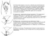 I. Изменение формы и высоты стояния дна матки (признак Шредера). Непосредственно после рождения плода форма матки округлая, дно ее находится на уровне пупка. После отделения плаценты матка уплощается, становится более узкой, дно ее поднимается (над отслоившейся плацентой) выше пупка иногда до реберн