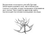 Выделение последа по способу Гентера (имитация родовых сил): кисти обеих рук, сжатые в кулаки, кладут тыльными сторонами на дно матки. При плавном давлении книзу происходит постепенное рождение последа.