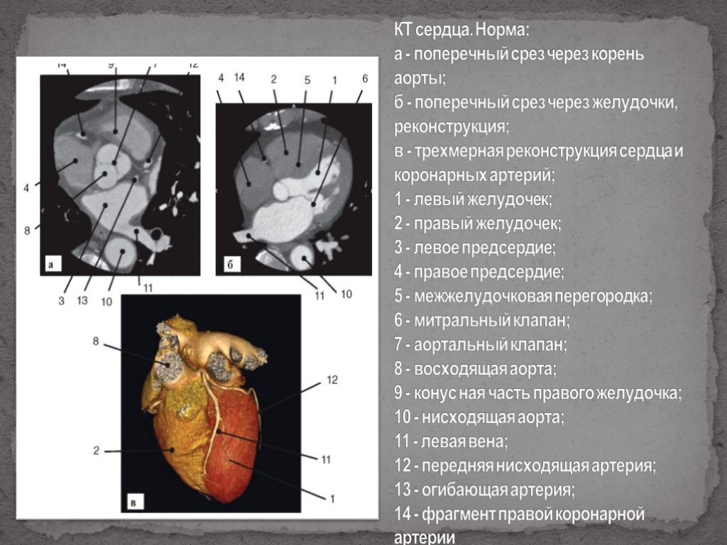 Кдр левого желудочка. Кт анатомия сердца. Размеры сердца на кт норма. Толщина желудочков сердца в норме.