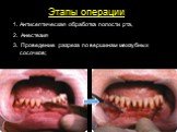Этапы операции Антисептическая обработка полости рта, Анестезия Проведение разреза по вершинам межзубных сосочков;