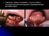4. Удаление зубных отложений с группы зубов, с последующей деэпителизацией и формированием десневого края.