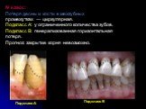 IV класс: Потеря десны и кости в межзубных промежутках — циркулярная. Подкласс А: у ограниченного количества зубов. Подкласс В: генерализованная горизонтальная потеря. Прогноз: закрытие корня невозможно.