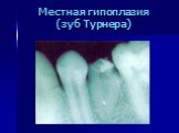 Местная гипоплазия (зуб Турнера)