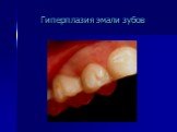 Гиперплазия эмали зубов