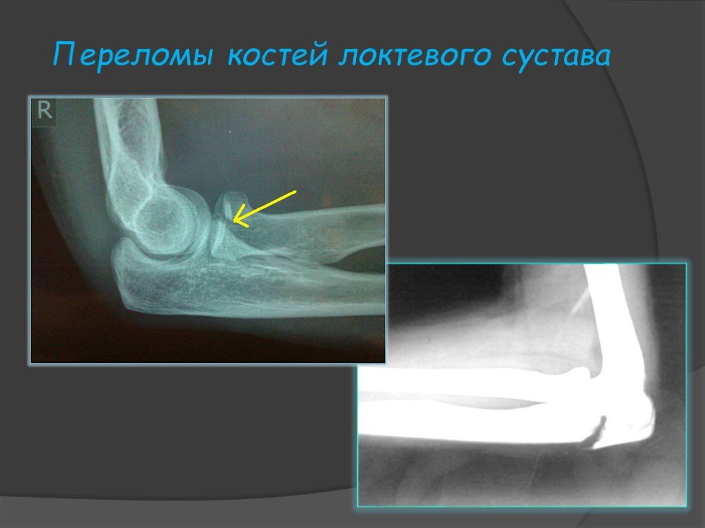 Перелом головки кости. Отрыв локтевого отростка рентген. Перелом лучевой кости в локтевом суставе рентген. Перелом венечного отростка локтевой кости со смещением рентген. Перелом головки лучевой кости рентген.