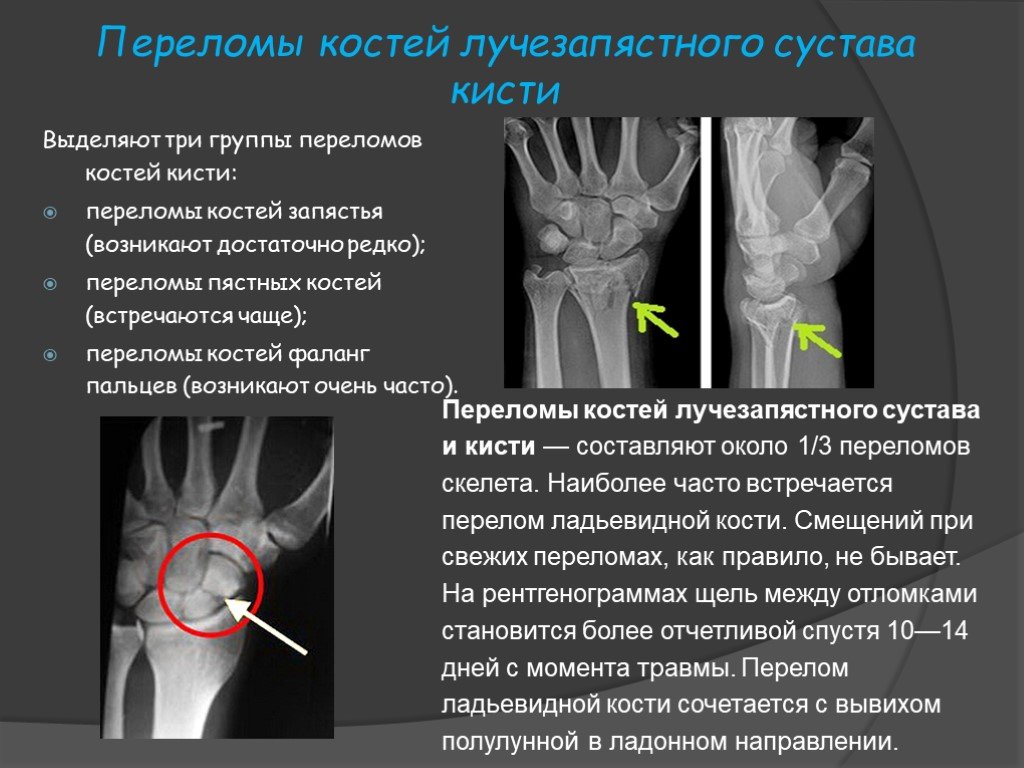 Ладьевидная кость кисти перелом лечение фото