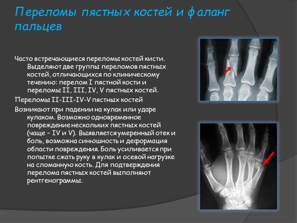 Повреждение кисти травматология презентация