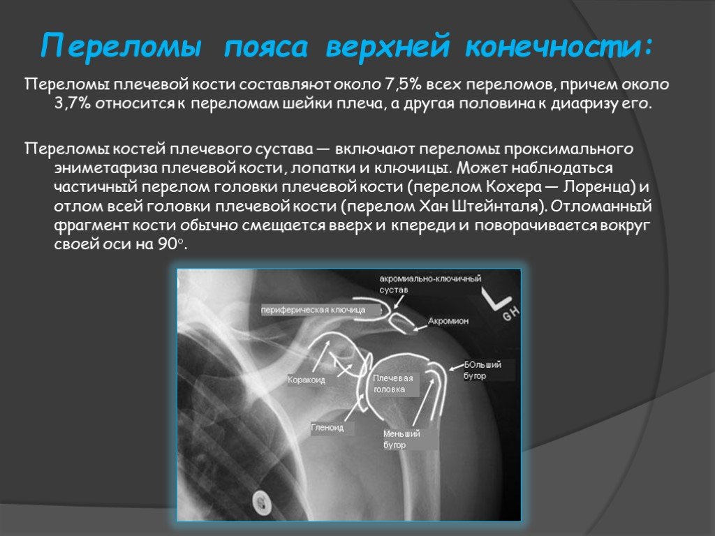 Переломы плечевой кости презентация