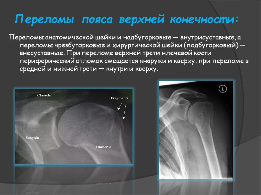 Травматология переломы презентация