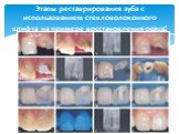 Этапы реставрирования зуба с использованием стекловолоконного штифта на примере восстановления резца: