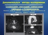 Однофотонная эмиссионная компьютерная томография с Tc-пирофосфатом: Является одним из наиболее современных методов дополнительной диагностики инфаркта миокарда.
