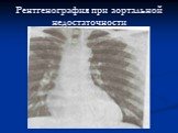 Рентгенография при аортальной недостаточности