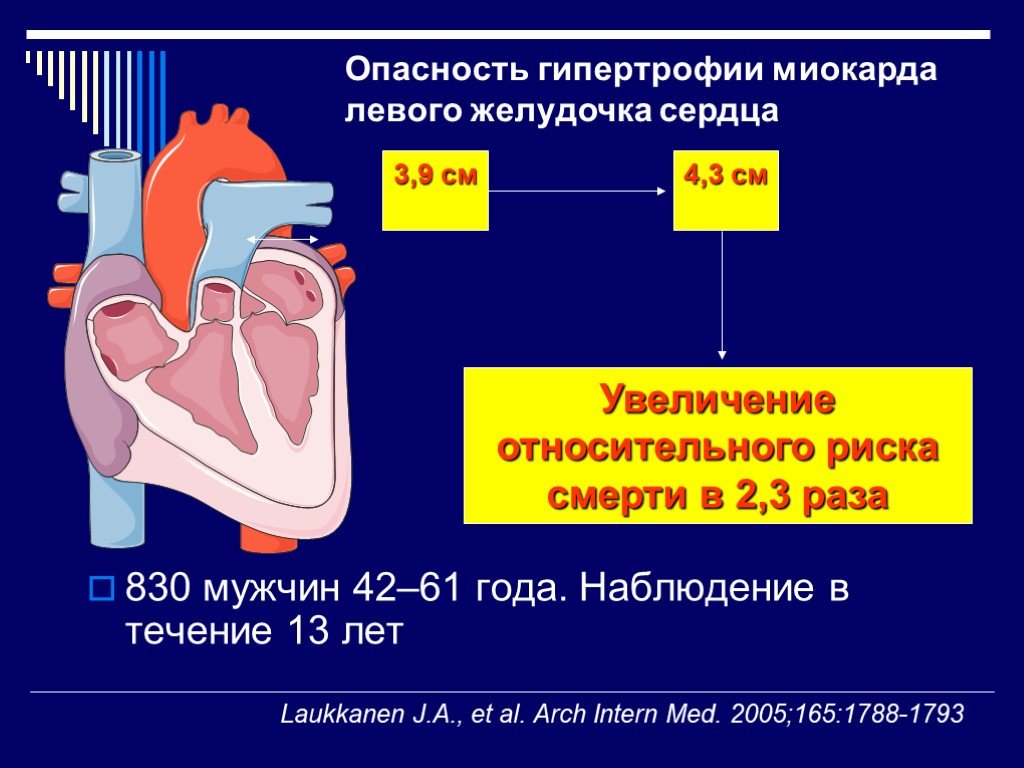 Миокард правого желудочка сердца. Гипертрофия миокарда левого желудочка. ИБС гипертрофия левого желудочка. Концентрическая гипертрофия левого желудочка УЗИ. Гипертрофия миокарда левого желудочка причины.