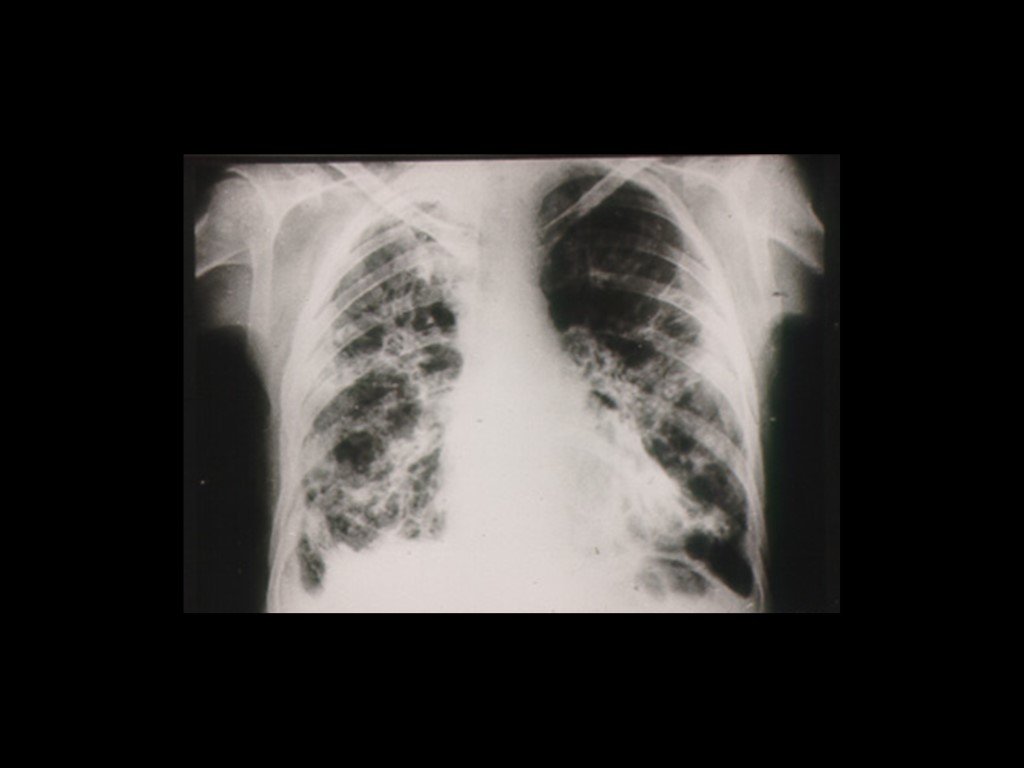 Диффузный пневмосклероз это рак. Пневмофиброз легкого рентгенография. Посттуберкулезный пневмофиброз. Диффузный пневмофиброз легких рентген.