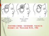 Декомпрессивная трепанация черепа по Кушингу (из: Матюшин И.Ф., 1982. образовано трепанационное отверстие и обнажена твердая мозговая оболочка. твердая мозговая оболочка рассечена. послойное ушивание раны