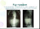 рентгенографию позвоночника в двух проекциях (в положении лежа на спине и на боку, соответствующему вершине деформации). Rg-графия