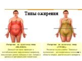 Типы ожирения. Ожирение по мужскому типу «ЯБЛОКО» Данный тип чаще приводит к метаболическим нарушениям( например, повышению уровня липидов и/ или сахара в крови) и к артериальной гипертонии. Ожирение по женскому типу «ГРУША» Развитие мышц слабое. Типичные осложнения – дегенеративные изменения в обла