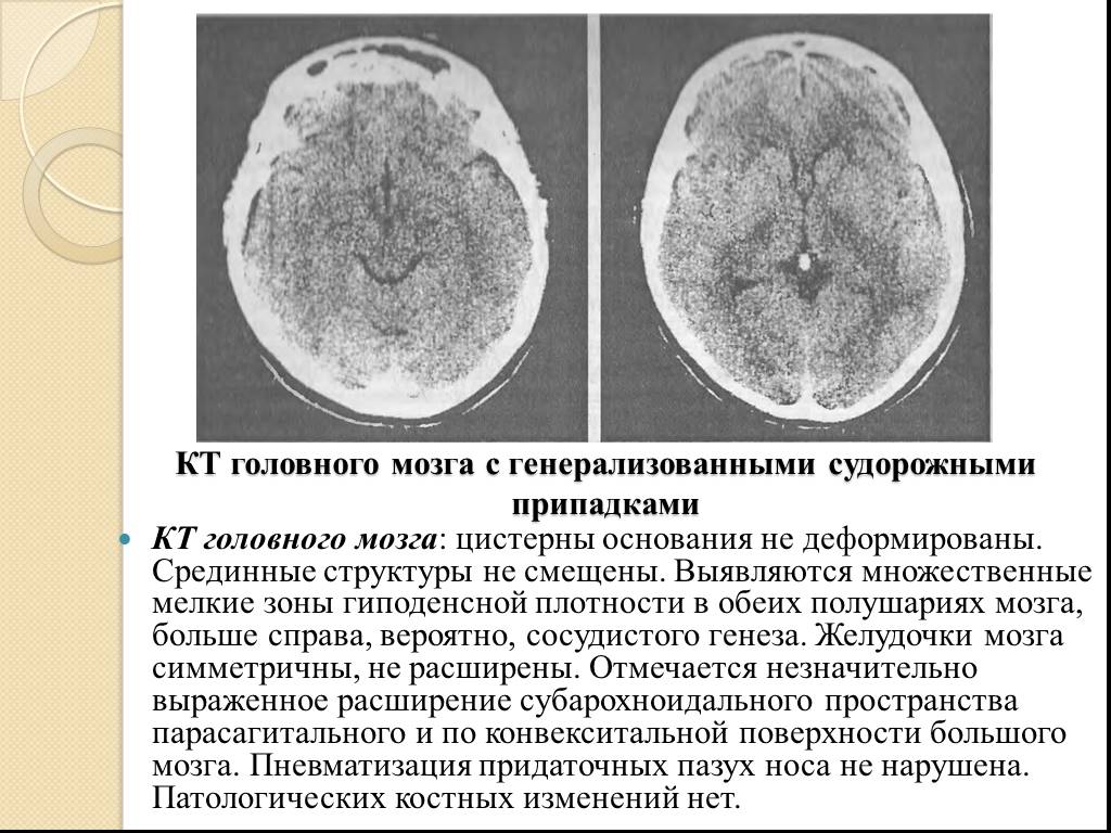 Мелкие очаги в головном мозге. Гиподенсивный очаг кт головного мозга. Гиподенсные очаги головного мозга на кт. Гиподенсный очаг на кт головного мозга. Образование головного мозга кт.
