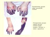 Отморожение пальцев обеих кистей II–III степени. Отморожение пальцев правой кисти IV степени (сухая гангрена пальцев) и левого предплечья.