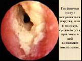 Гнойнички могут вскрываться наружу или в полость среднего уха, при этом в ней возникает воспаление.
