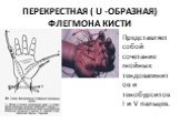 ПЕРЕКРЕСТНАЯ ( U -ОБРАЗНАЯ) ФЛЕГМОНА КИСТИ. Представляет собой сочетание гнойных тендовагинитов и тенобурситов I и V пальцев.