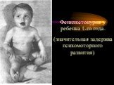 Фенилкетонурия у ребенка 1-го года. (значительная задержка психомоторного развития)