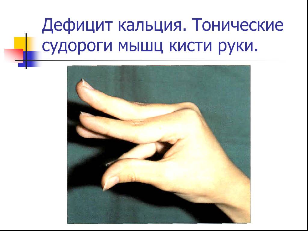 Сводит судорогой пальцы рук причина. Тонические судороги мышц кисти руки. Дефицит кальция. Судороги нехватка кальция.