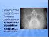На рентгенограмме в аксиальной проекции определяется деформация скуловой дуги, возможно нарушение её непрерывности. Перелом скуловой дуги может сочетаться с переломом скуловой кости. При этом образующийся угол смещения костных отломков чаще направлен в сторону подвисочной ямки.