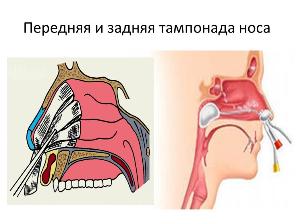 Передняя тампонада при носовом кровотечении
